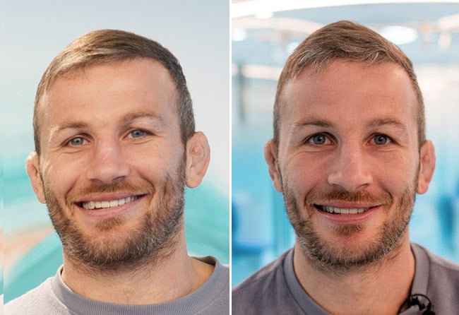 Nachher Vergleich der DHI Haartransplantation mit 5700 Grafts bei Patient Stephan Pütz