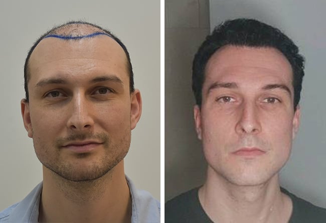 Maximilian B. vor- und nach seiner DHI-Haartransplantation bei Elithair