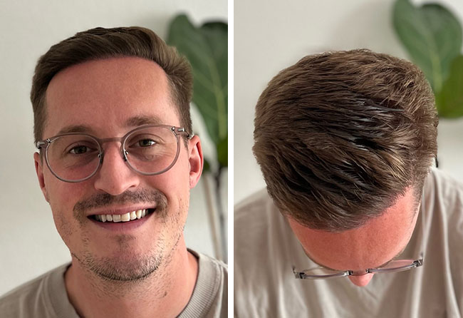 Endergebnis der Haartransplantation bei Christopher L.