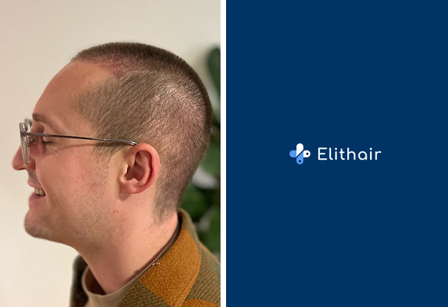 Aufnahme von Christopher L. kurz nach dem Eingriff bei Elithair.