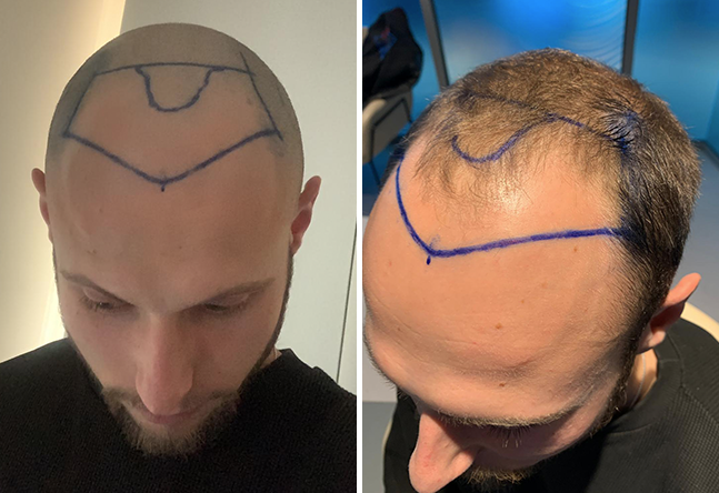 Vorher DHI Haartransplantation mit 4000 Grafts bei Patient Niklas N.
