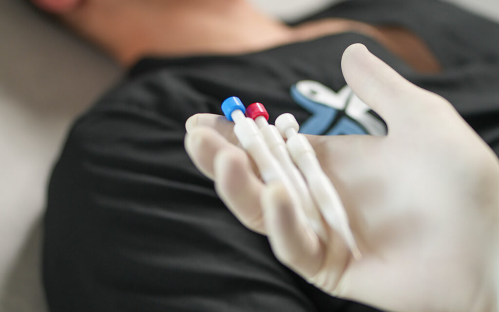 DHI Methode: Arzt hält vorbereitete Choi-Implanter-Stifte