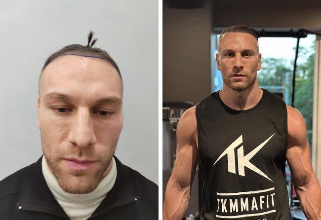 Kerim Engizek Nachher