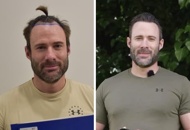 Otto Bulletproof Haartransplantation bei Elithair