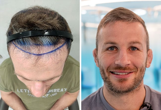 Stephan P&uuml;tz Haartransplantation bei Elithair
