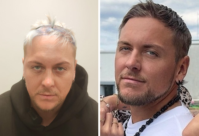 Danny Liedtke Haartransplantation bei Elithair