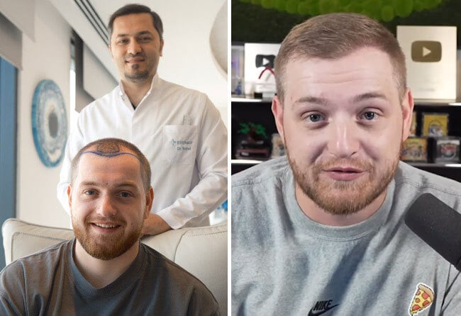 Trymacs Haartransplantation bei Elithair