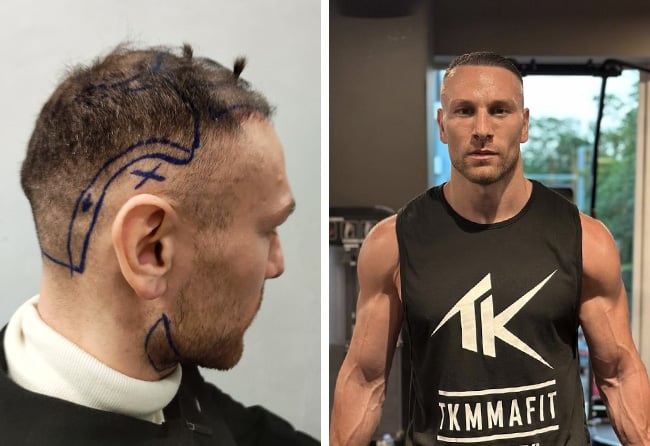 Kerim Engizek Haartransplantation bei Elithair