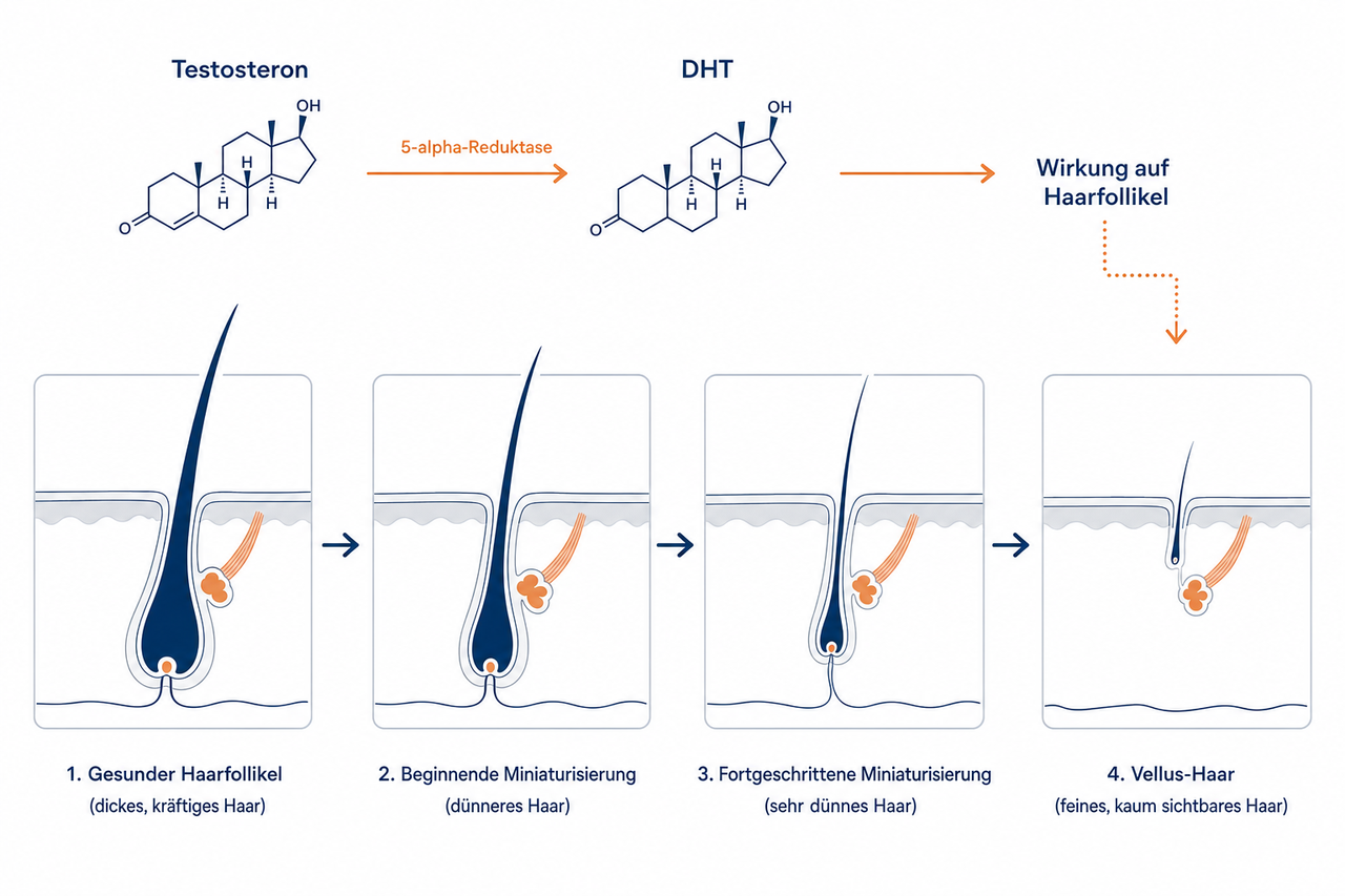 Infografik: Testosteron wird über die 5-alpha-Reduktase zu DHT und führt zur Miniaturisierung der Haarfollikel