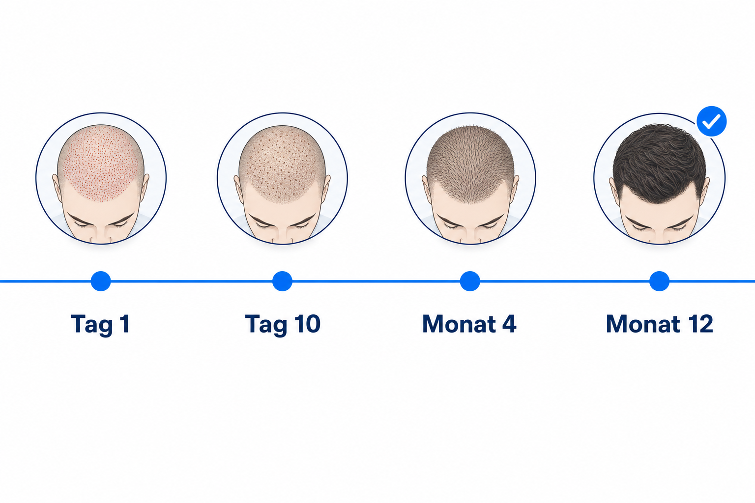 Heilungsverlauf nach Haartransplantation ohne Rasur von Tag 1 bis Monat 12