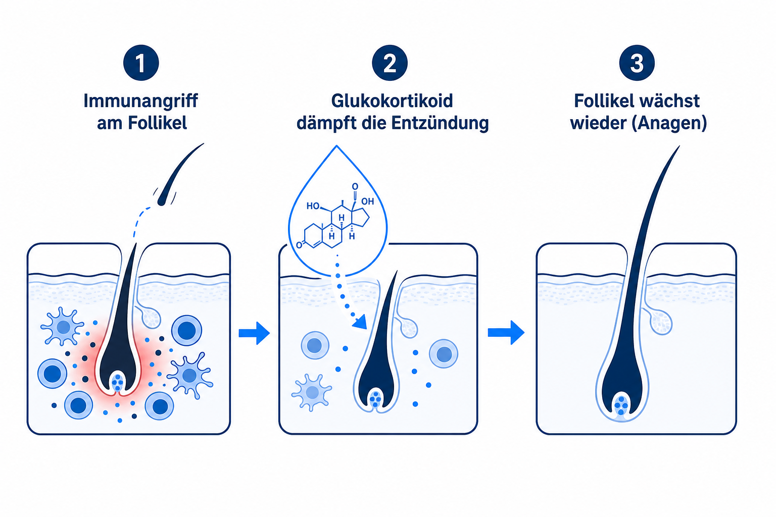 Infografik: Wie Glukokortikoide den Immunangriff am Haarfollikel dämpfen und das Nachwachsen ermöglichen