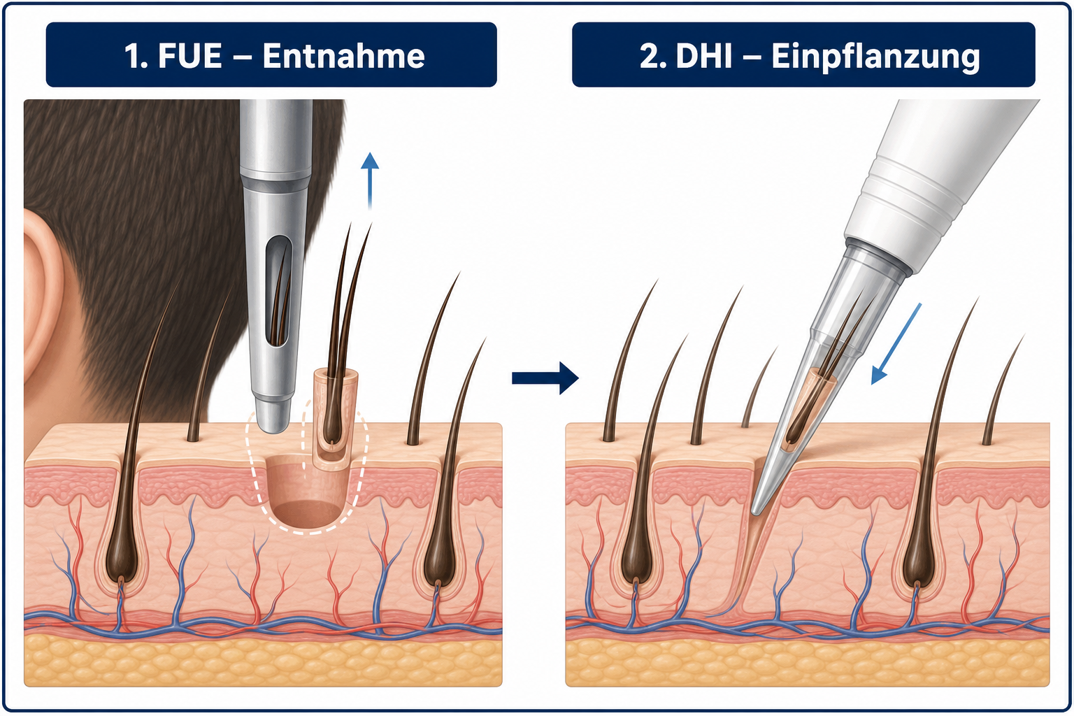 Ablauf einer Haartransplantation: FUE-Entnahme der Grafts links, DHI-Einpflanzung mit CHOI-Pen rechts