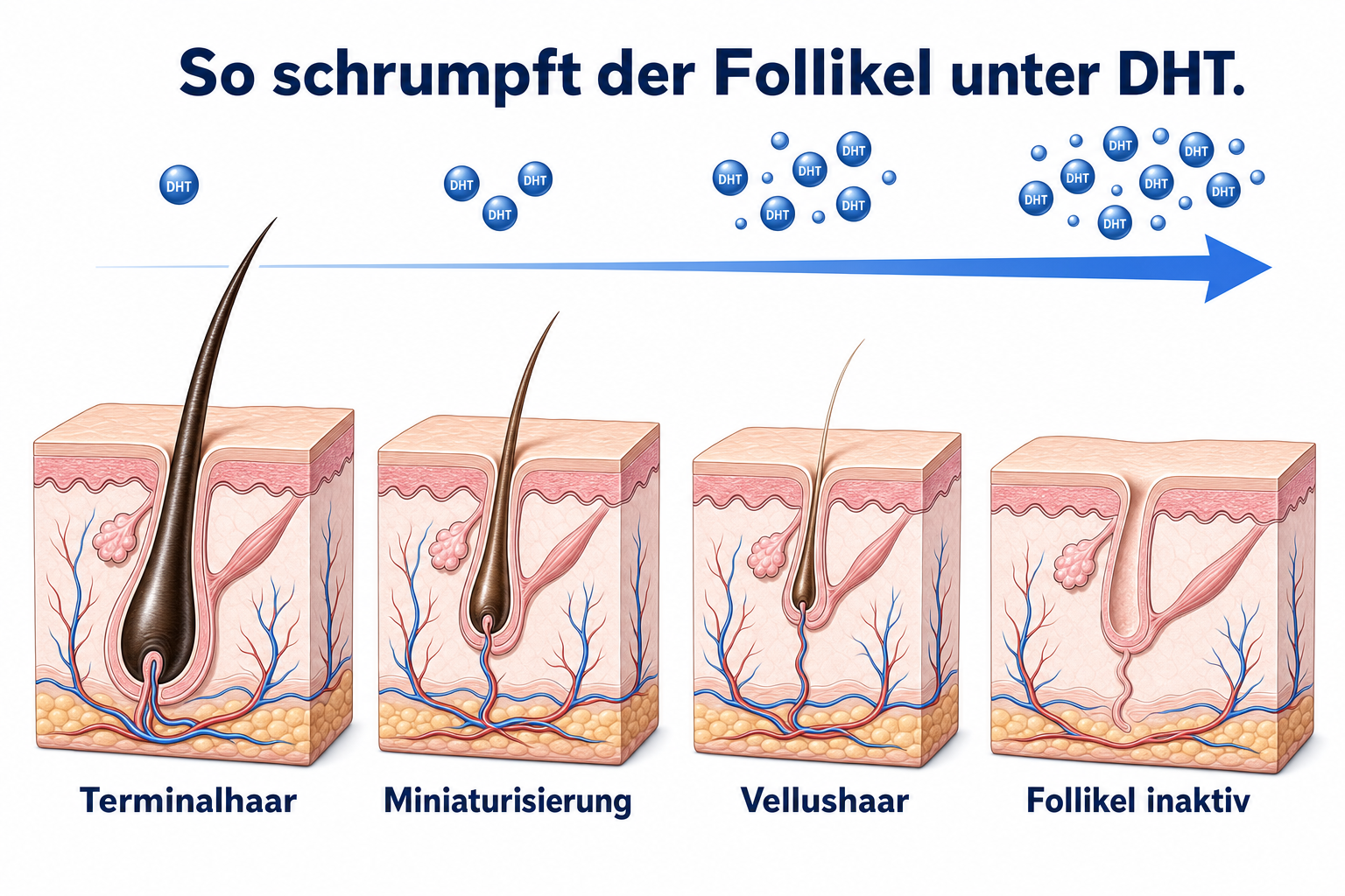 Medizinische Illustration der Follikel-Miniaturisierung durch DHT: vom kräftigen Terminalhaar über Vellushaar bis zum inaktiven Follikel