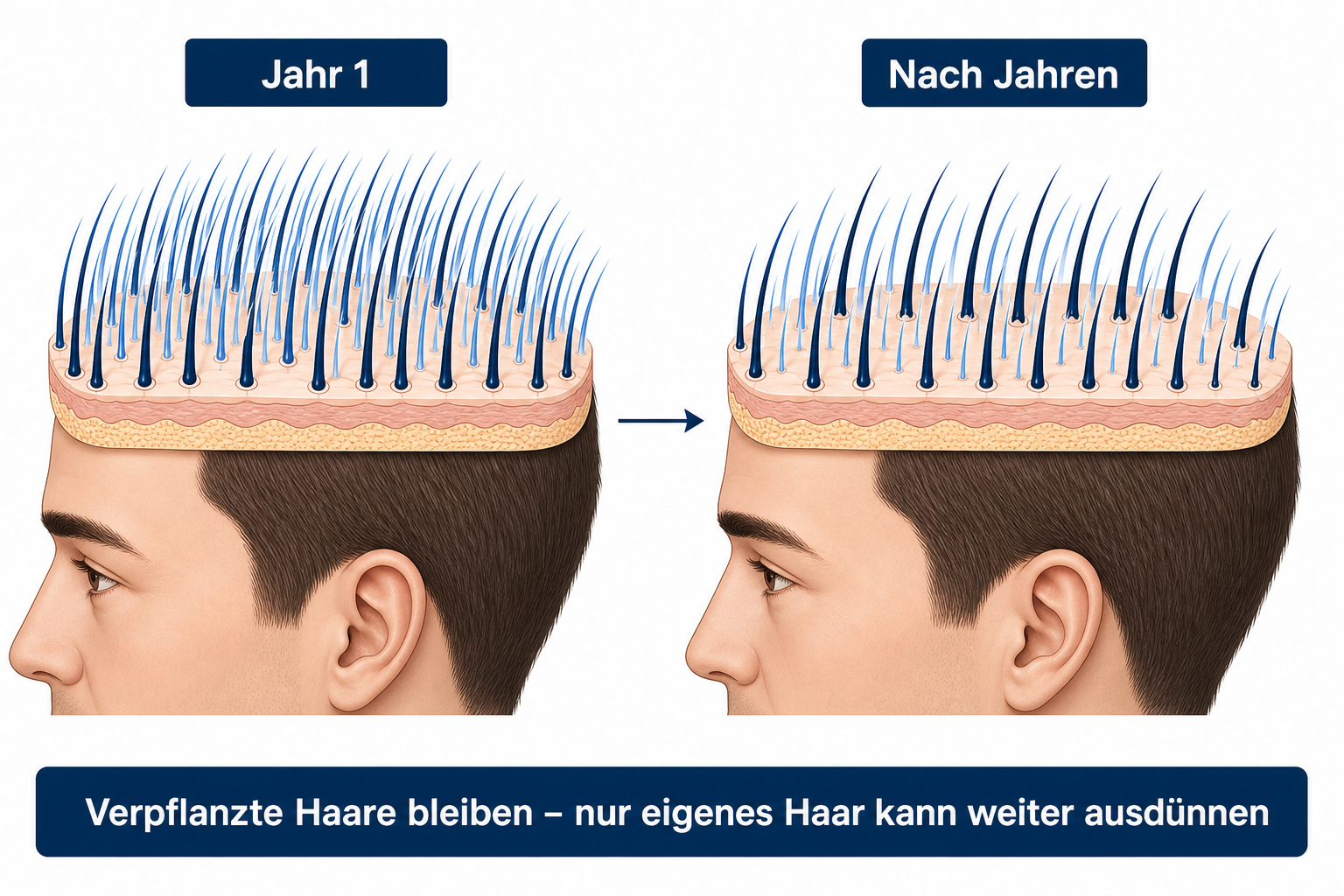 Verpflanzte Haare bleiben dauerhaft, nur das eigene Haar dazwischen kann über die Jahre weiter ausdünnen