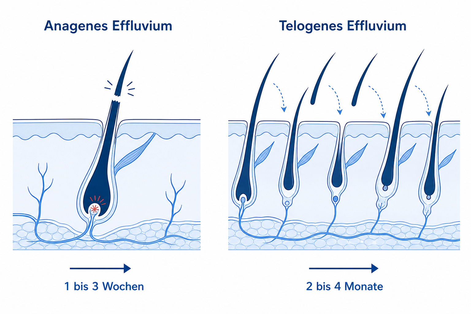Vergleich anagenes und telogenes Effluvium: Haarbruch in der Wachstumsphase nach 1 bis 3 Wochen gegenüber diffusem Ausfall in der Ruhephase nach 2 bis 4 Monaten