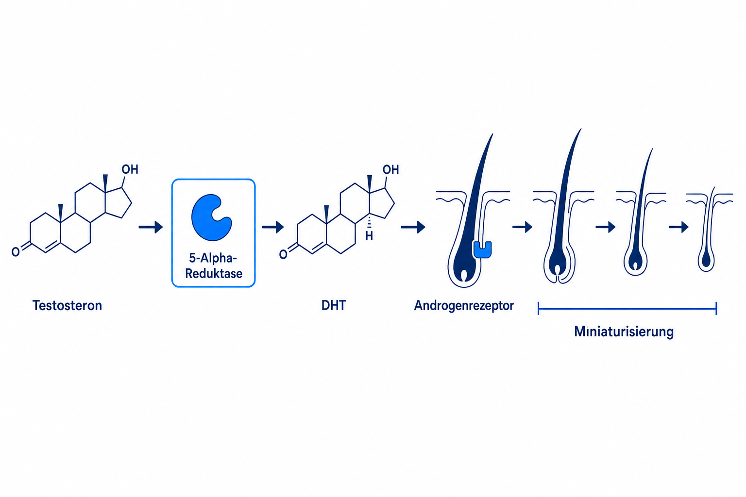 Diagramm der DHT-Wirkkette: Testosteron, 5-Alpha-Reduktase, DHT und Miniaturisierung des Schläfenfollikels
