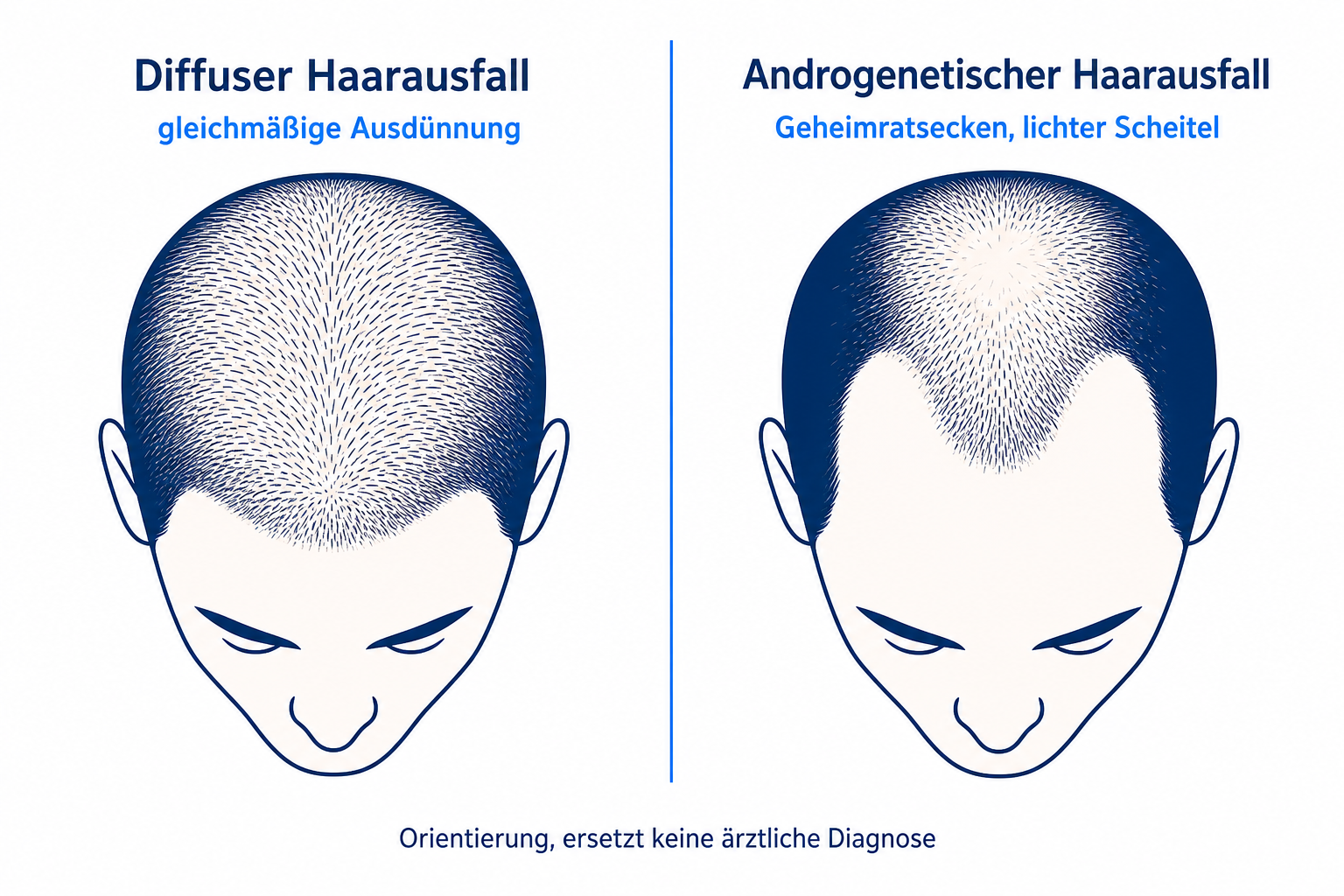 Vergleichsdiagramm diffuser versus androgenetischer Haarausfall, zwei Kopf-Silhouetten mit Ausdünnungsmuster