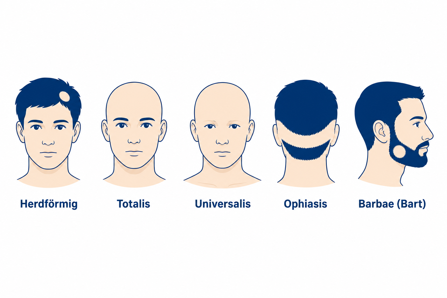 Formen des kreisrunden Haarausfalls: herdförmig, totalis, universalis, Ophiasis und Barbae