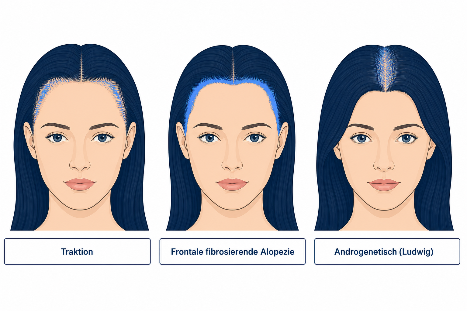 Drei weibliche Kopf-Diagramme im Vergleich: Traktion, frontale fibrosierende Alopezie und androgenetisches Ludwig-Muster
