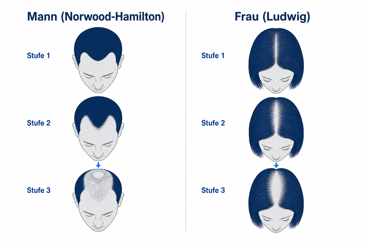 Schematischer Vergleich der Haarausfallmuster bei Mann (Norwood-Hamilton) und Frau (Ludwig) bei androgenetischer Alopezie