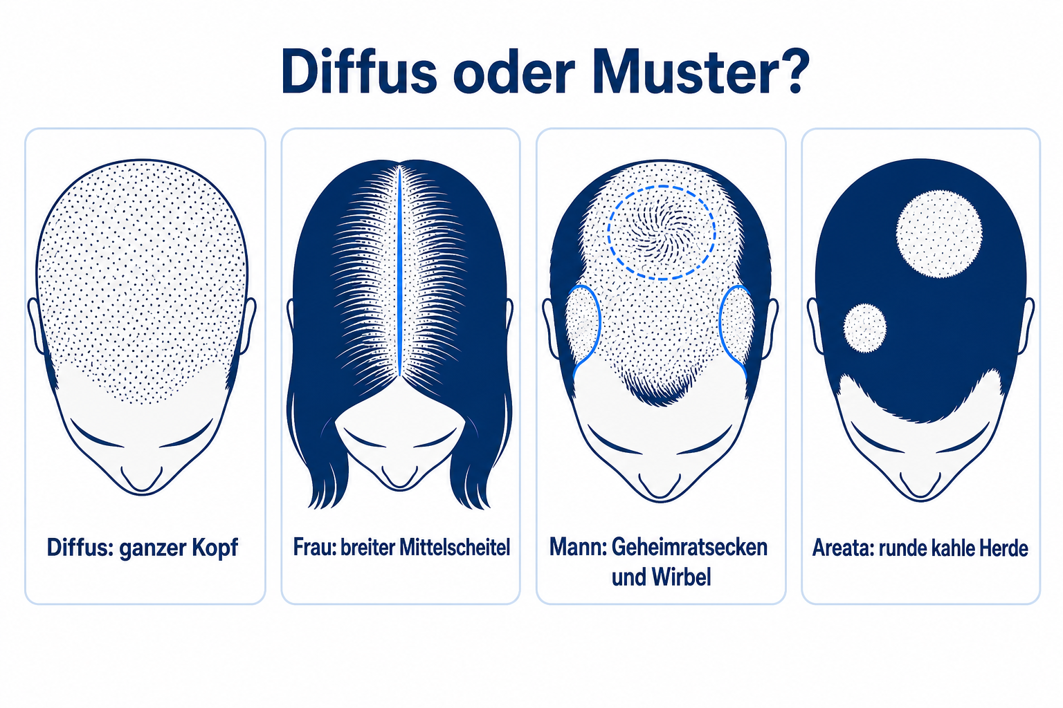 Vergleich von vier Haarausfall-Mustern: diffuse Ausdünnung am ganzen Kopf, breiter Mittelscheitel bei der Frau, Geheimratsecken und Wirbel beim Mann, runde kahle Herde bei Alopecia areata
