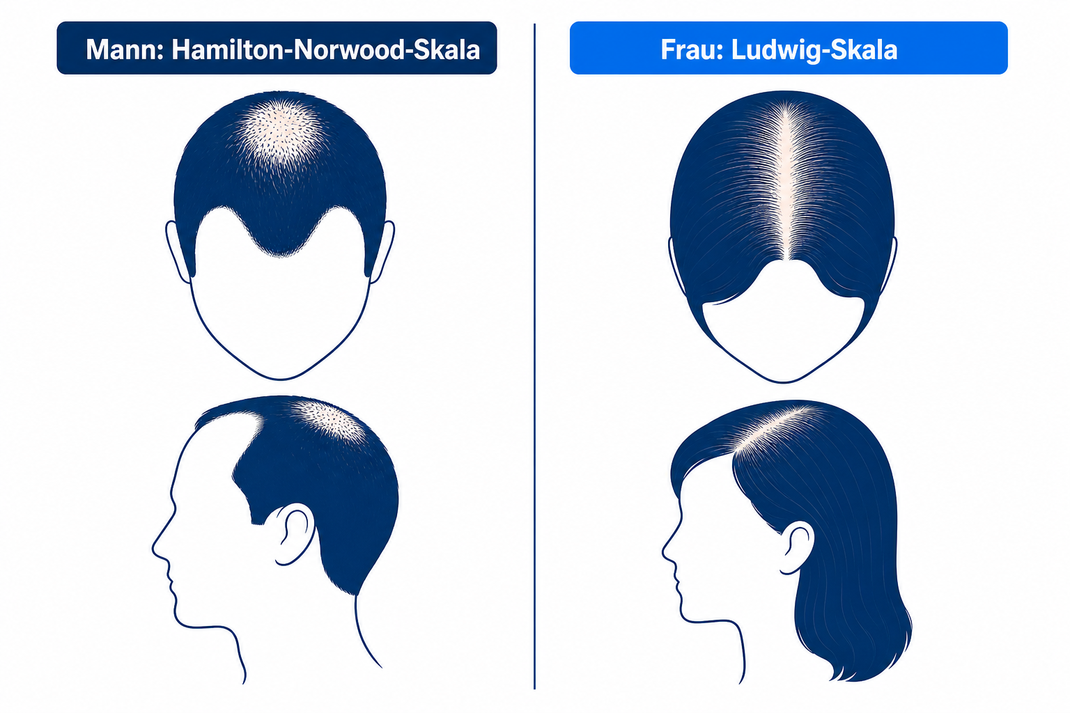 Vergleich der androgenetischen Haarausfall-Muster bei Mann (Hamilton-Norwood-Skala) und Frau (Ludwig-Skala) nebeneinander
