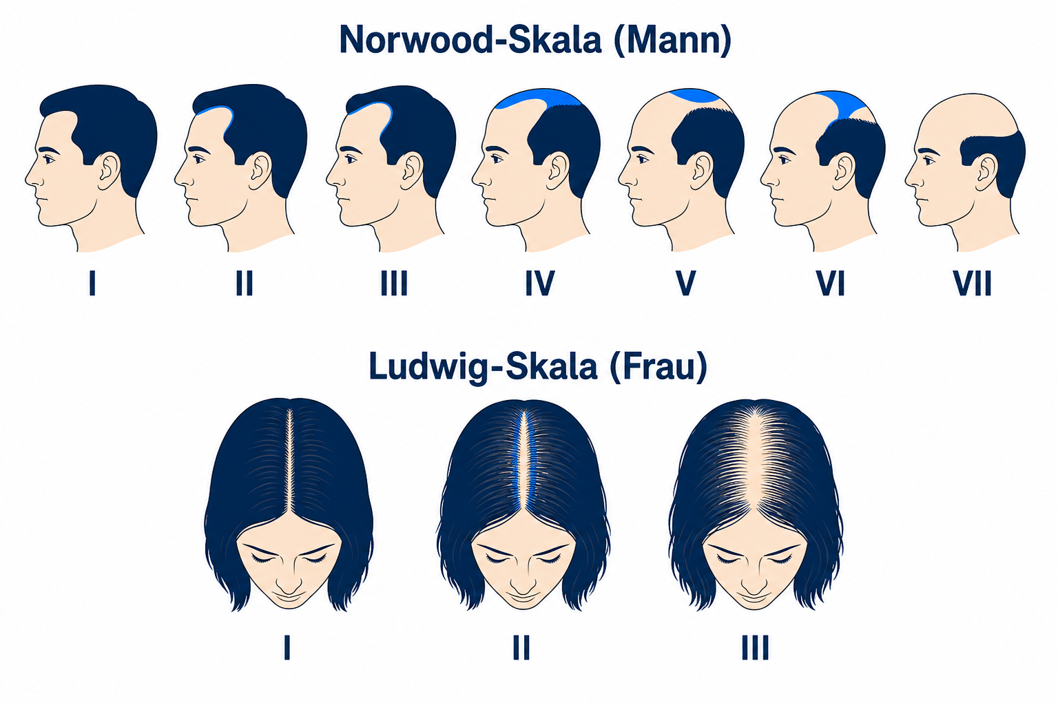 Norwood-Skala fuer Maenner und Ludwig-Skala fuer Frauen zur Einordnung des Muster-Haarausfalls