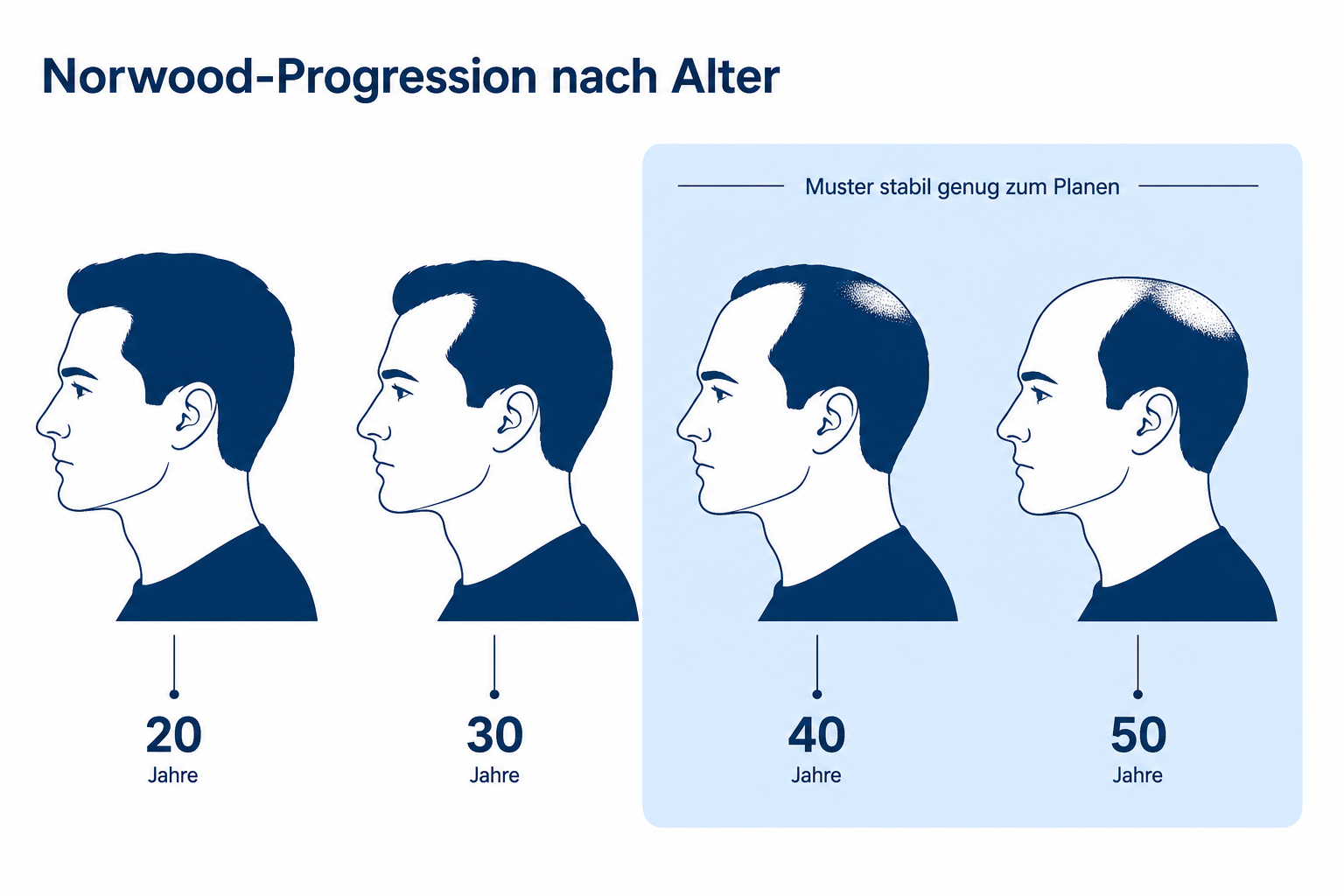 Zeitachse der Norwood-Progression: fortschreitender Haarausfall mit steigendem Alter