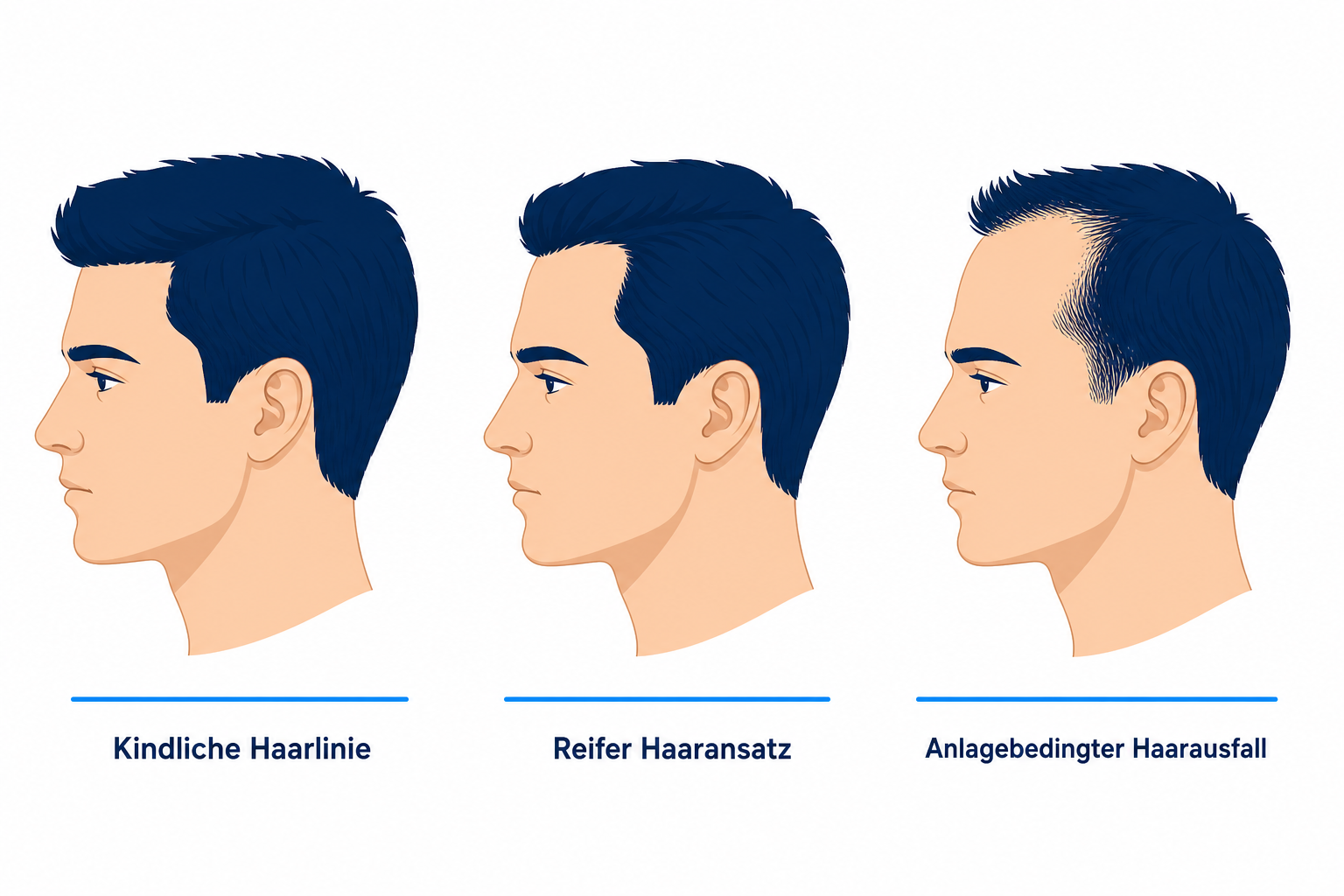 Drei Kopf-Profile im Vergleich: kindliche Haarlinie, reifer Haaransatz und anlagebedingter Haarausfall