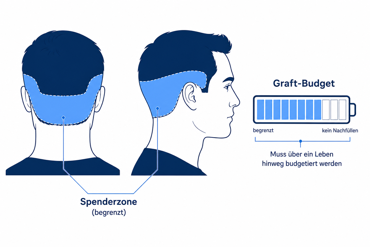 Diagramm der begrenzten Spenderzone am Hinterkopf als lebenslanges Graft-Budget