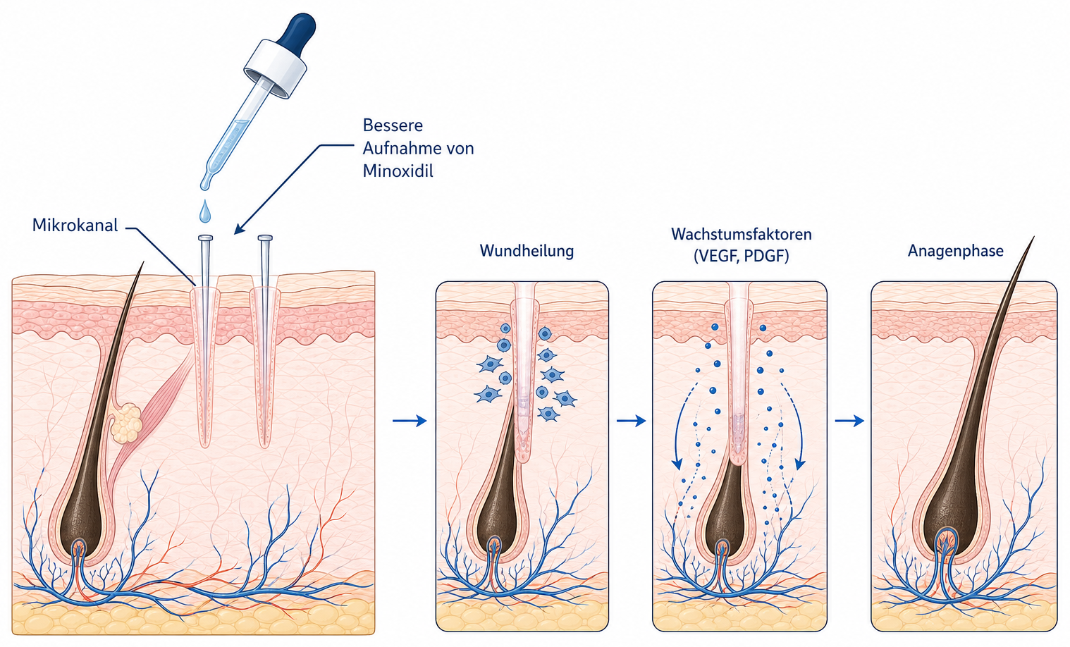 Illustration des Wirkmechanismus von Microneedling auf der Kopfhaut: Mikrokanal, Wundheilung, Wachstumsfaktoren und Anagenphase