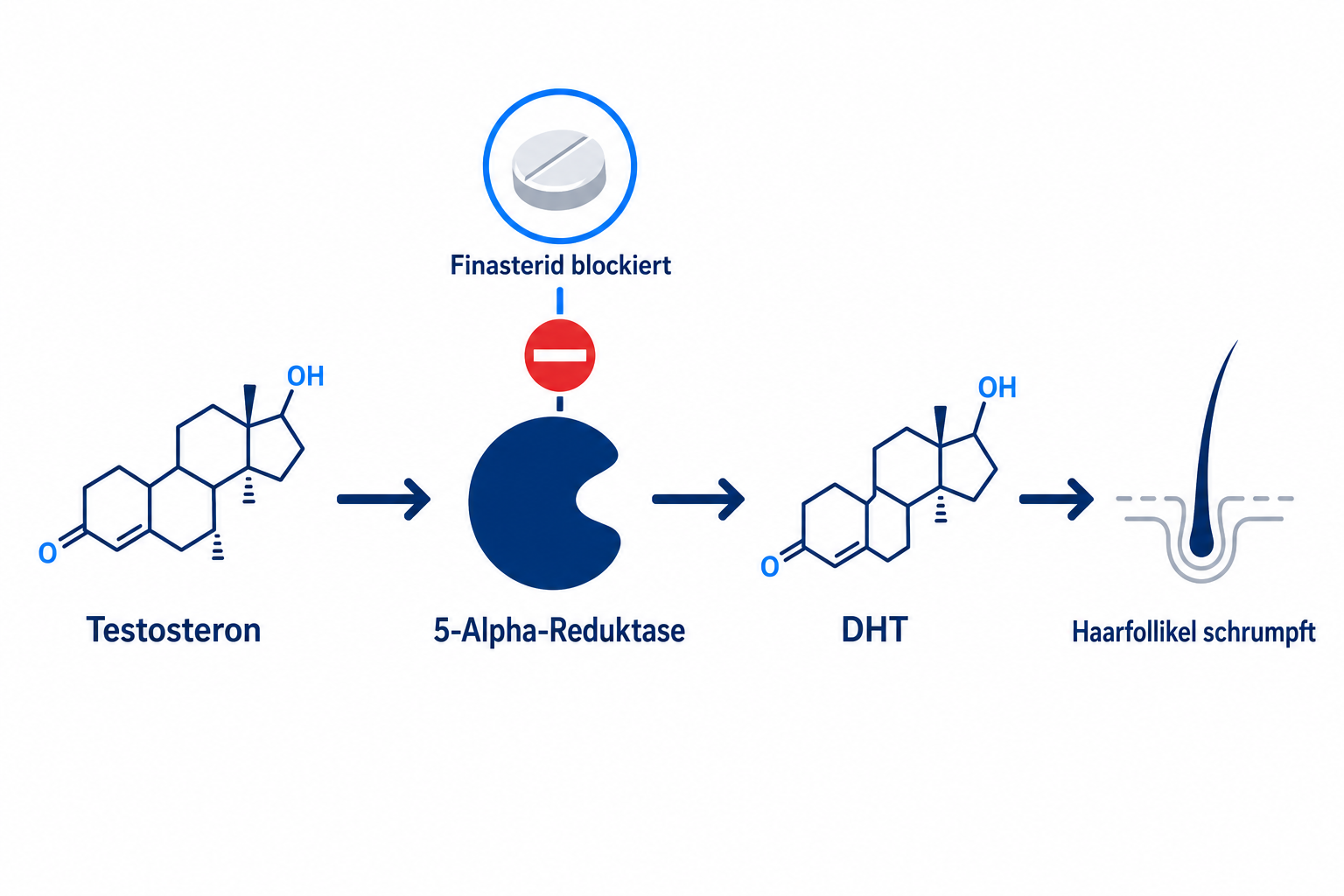 Diagramm des Finasterid-Wirkmechanismus: Finasterid blockiert die 5-Alpha-Reduktase und senkt DHT