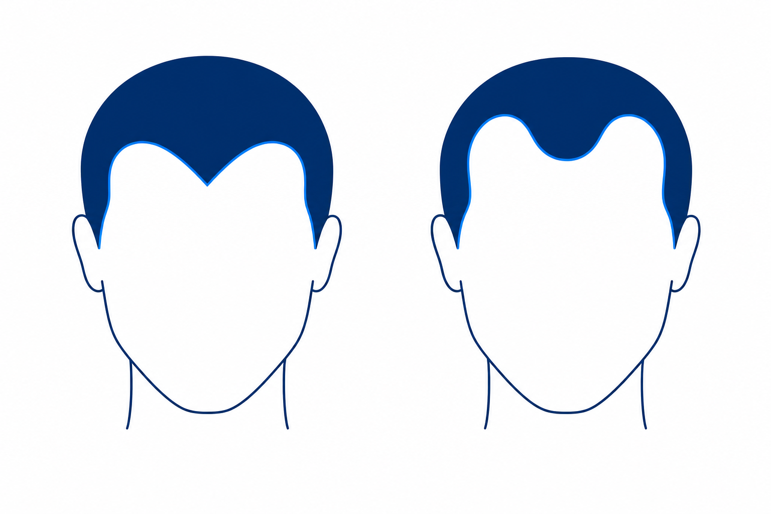 Vergleich zweier Kopf-Silhouetten von vorne: links zentrale Witwenspitze, rechts M-förmige Geheimratsecken
