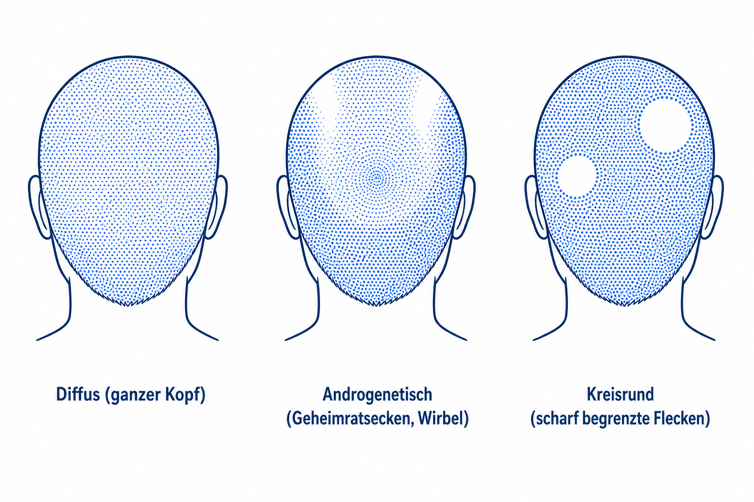Vergleich der drei Ausfallmuster: diffus, androgenetisch und kreisrund als Kopf-Silhouetten
