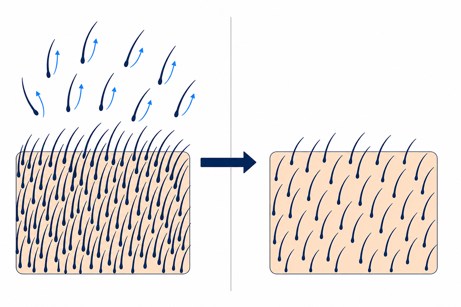Illustration: Effluvium als Vorgang des Ausfallens gegenüber Alopezie als verminderte Haardichte