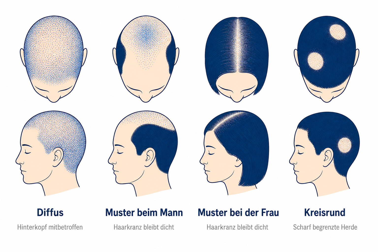 Infografik: diffuser Haarausfall, männliches und weibliches Muster sowie kreisrunder Haarausfall im Vergleich