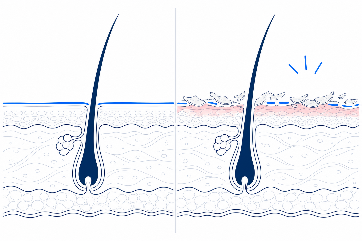 Illustration der Kopfhaut im Querschnitt: links intakte Hautbarriere, rechts Rückstände aus Kalkseife und Tensiden mit trockener Schuppung und Rötung