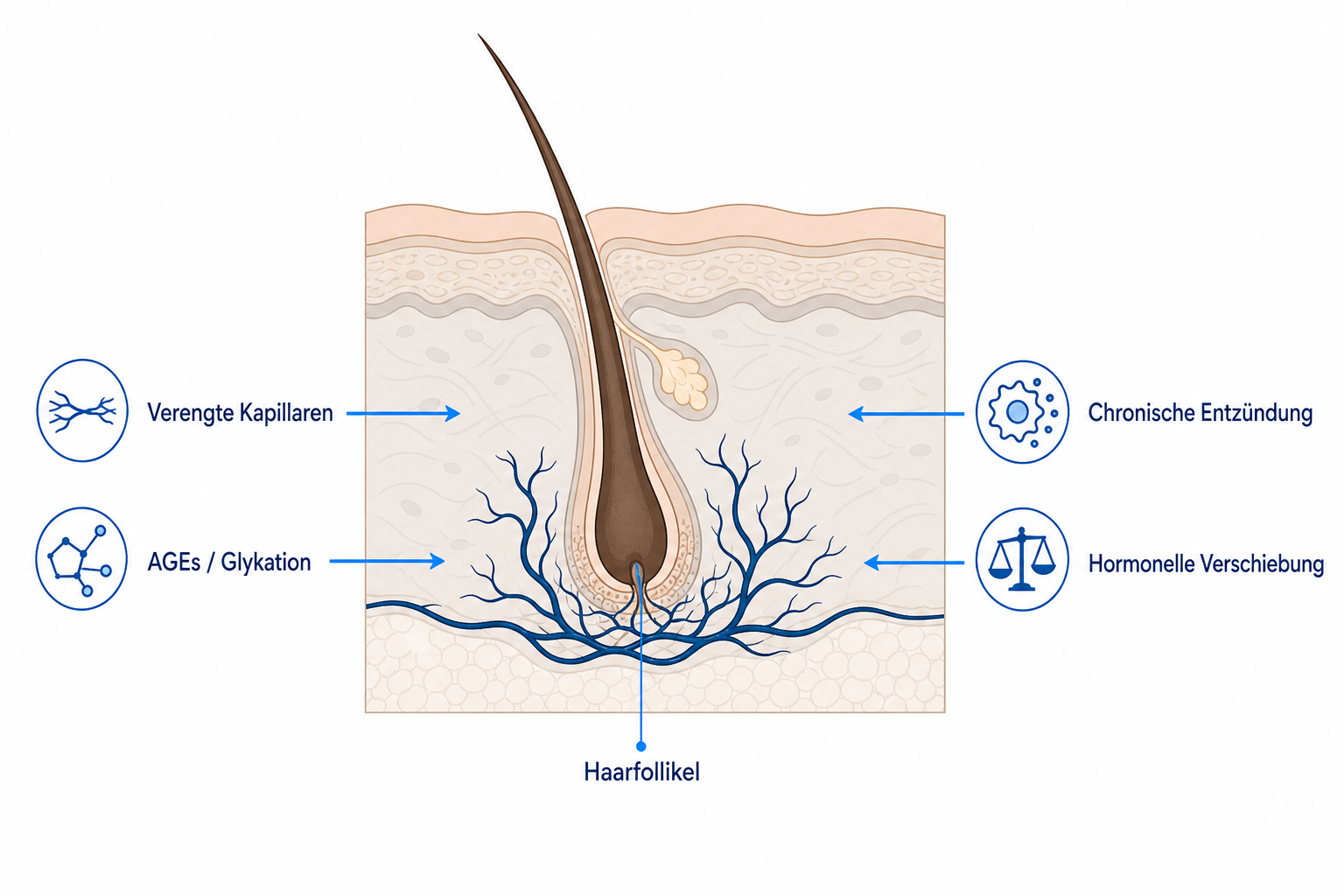 Illustration eines Haarfollikels im Hautquerschnitt mit den vier Mechanismen, über die Diabetes den Haarwuchs stört