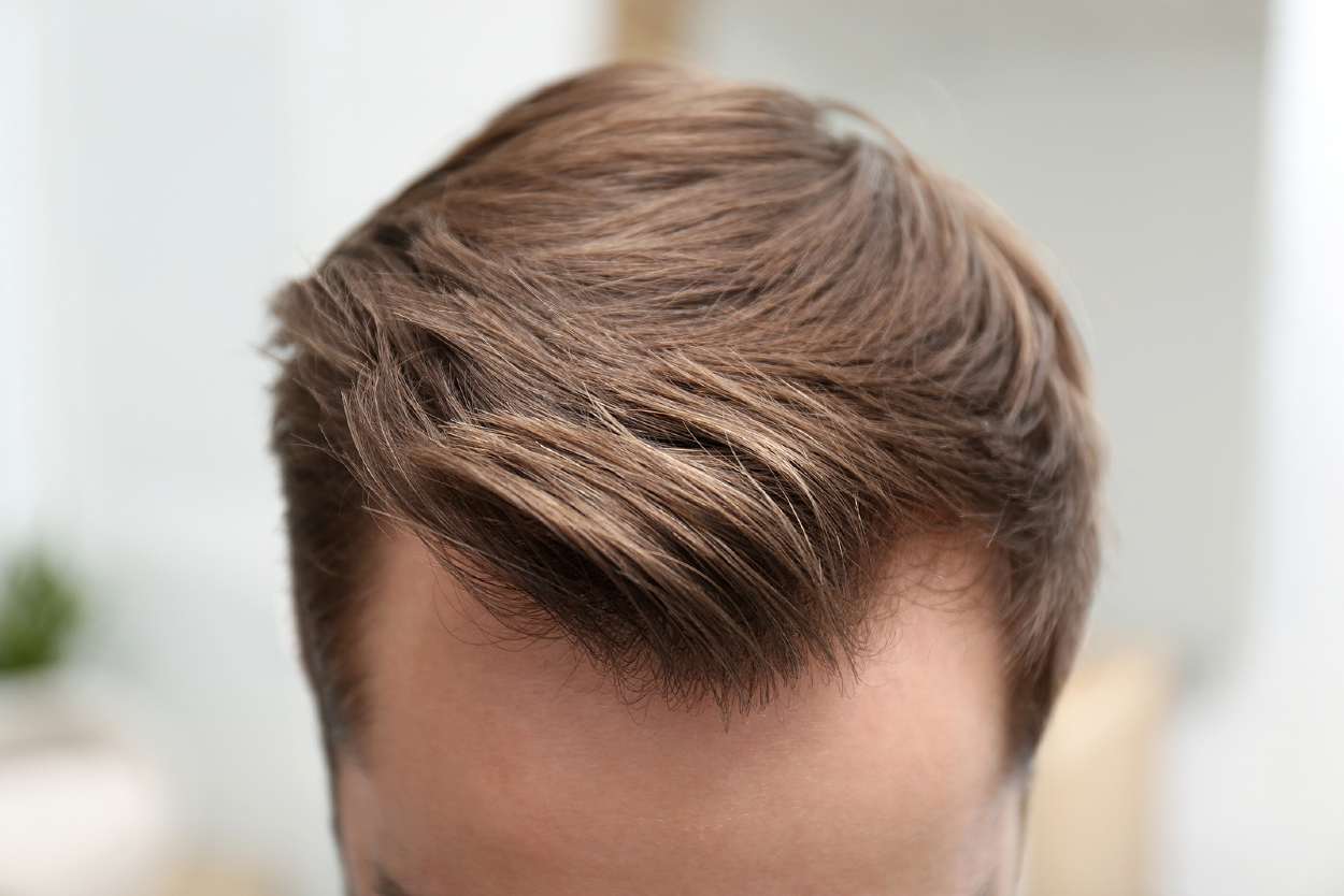 Hombre joven con entradas en el cabello