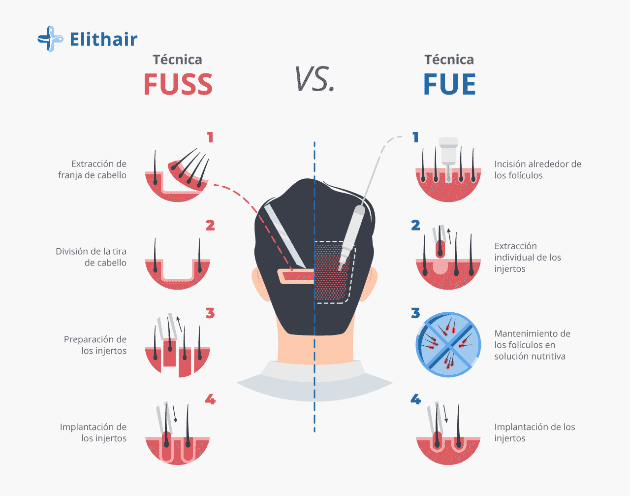 Comparativa técnica capilar FUSS vs FUE