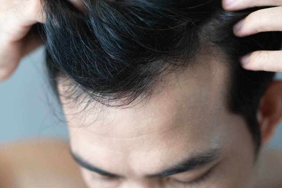 Hombre con entradas leves y cabello oscuro