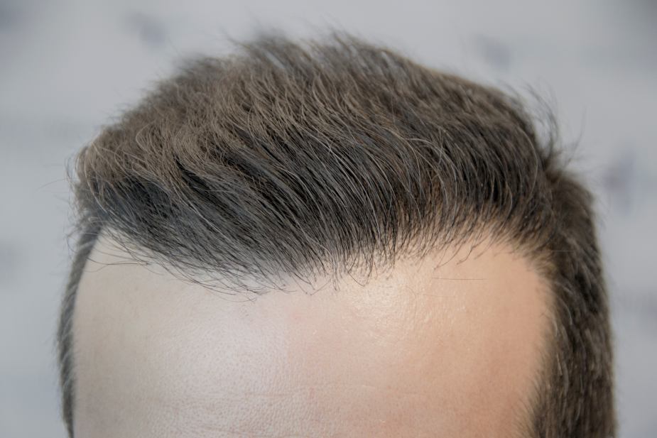 Trasplante capilar de un paciente de Elithair