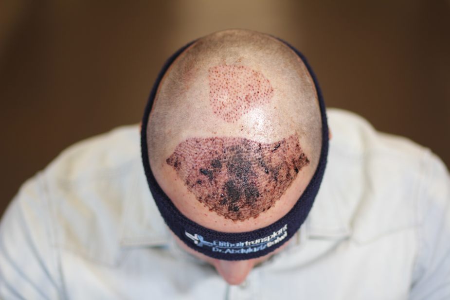 Vista superior de un paciente de Elithairtransplant con la cinta elástica recomendada