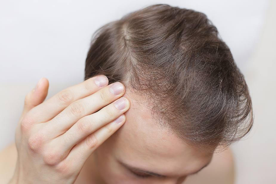 Hombre con caída excesiva del cabello en las entradas.