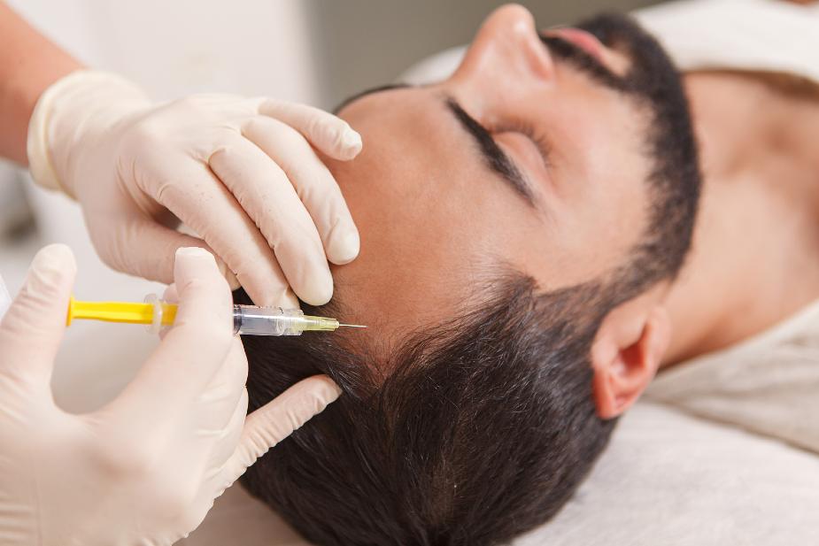 Tratamiento con agujas contra la caída del cabello.