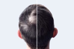 Antes y después del injerto capilar para ganar densidad capilar