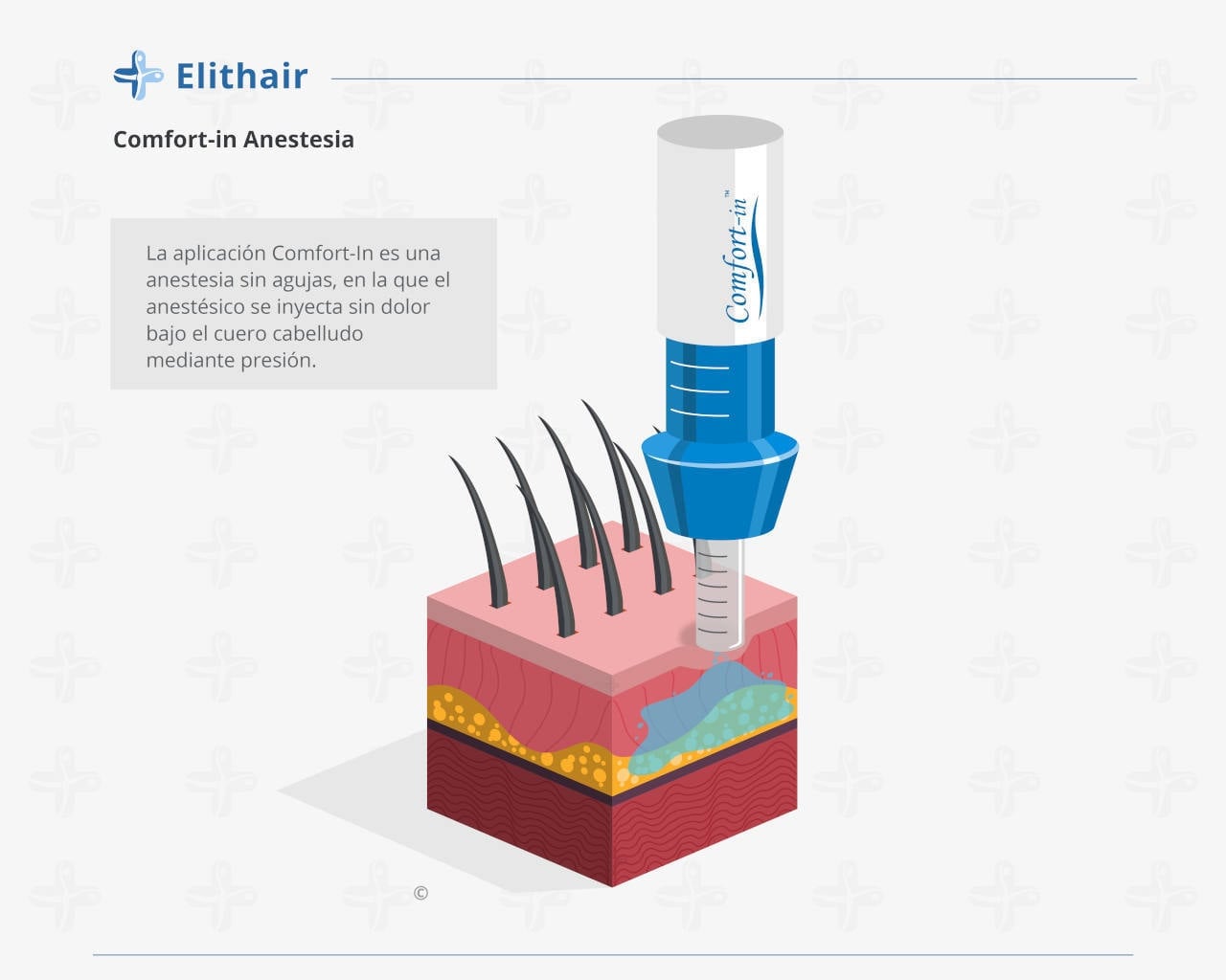 Elithairtransplant Infográfica anestesia injerto capilar
