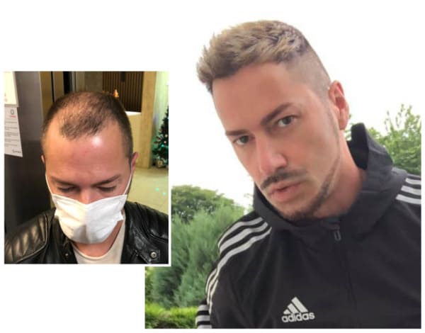 Andre O.: Imágenes antes y después - 5200 Grafts | Elithair