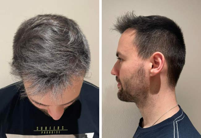 Imagen 5 meses después del trasplante capilar FUE Zafiro de 2700 grafts del paciente Thorsten S.
