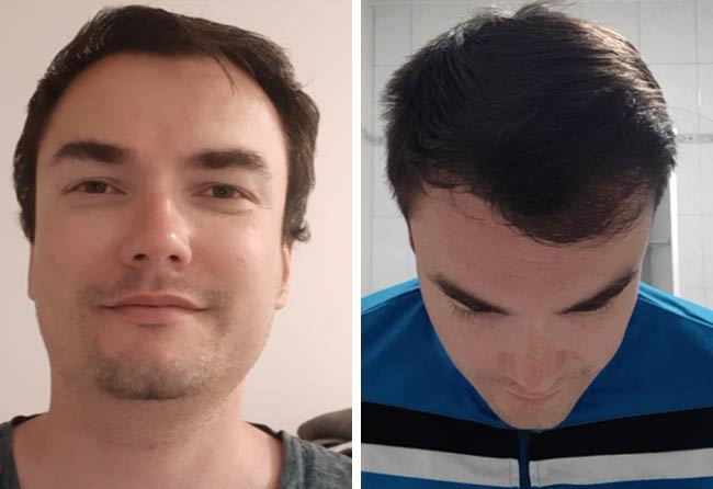 Antes y despues del injerto capilar de Chris S. con 3500 grafts a los 7 meses